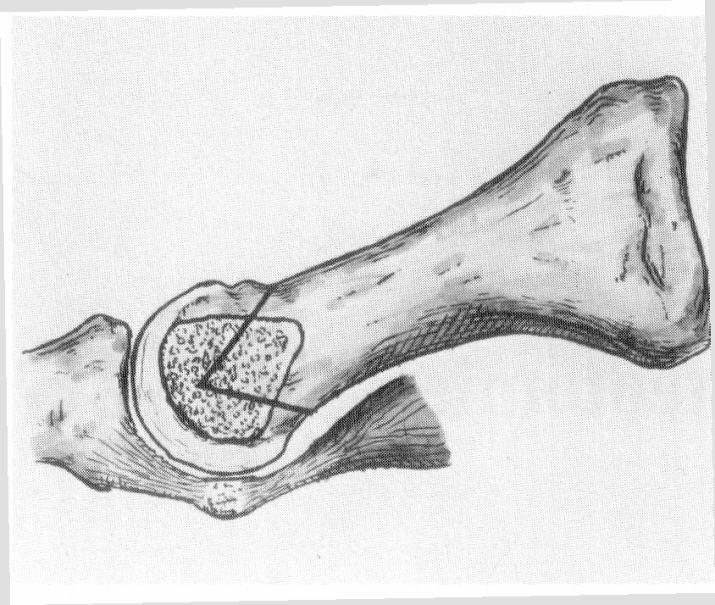 Austin-Osteotomie